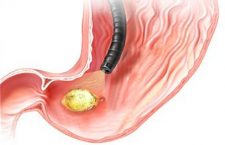 Bolile toamnei: ulcerul gastric şi duodenal